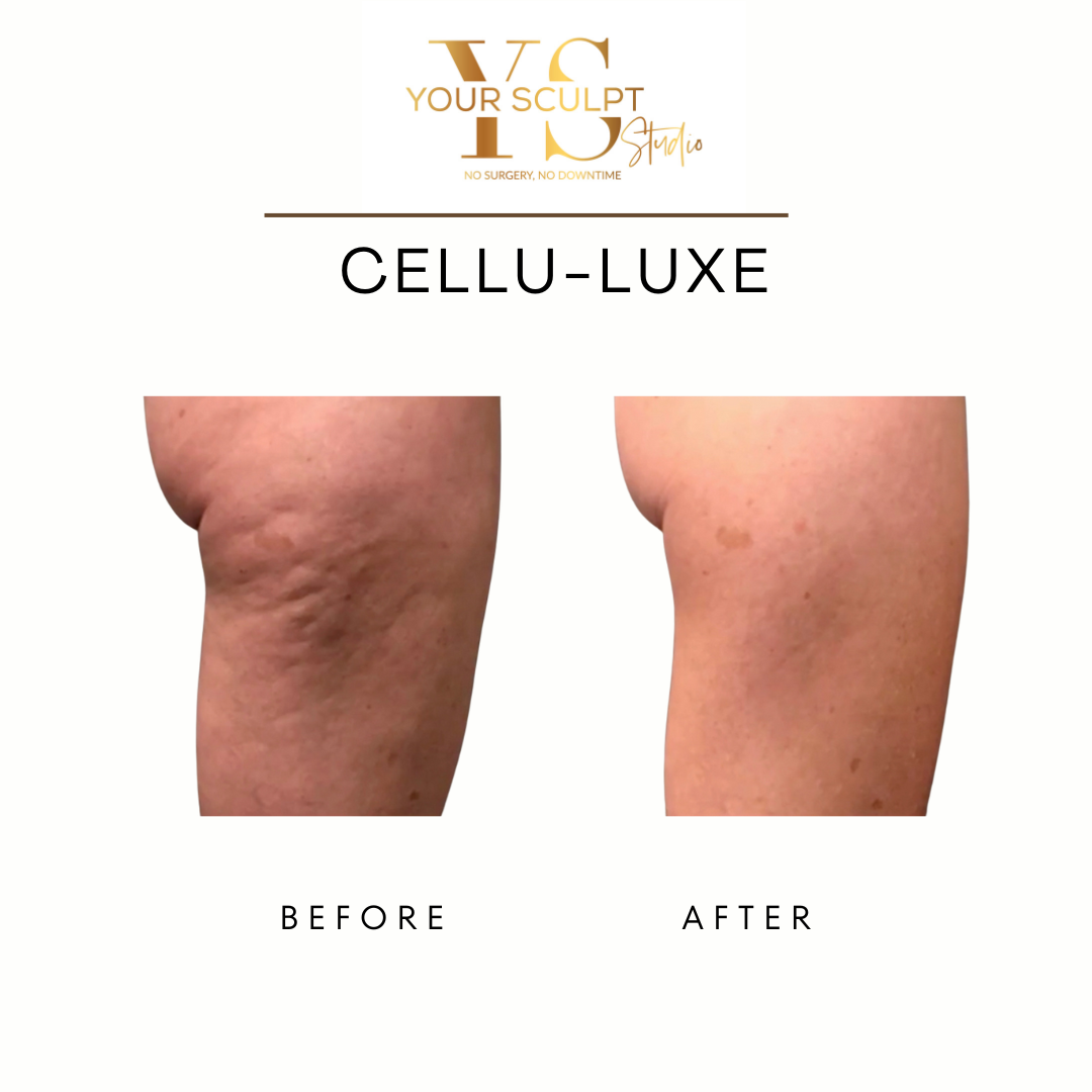 Before and After Cellulite Reduction on Thighs