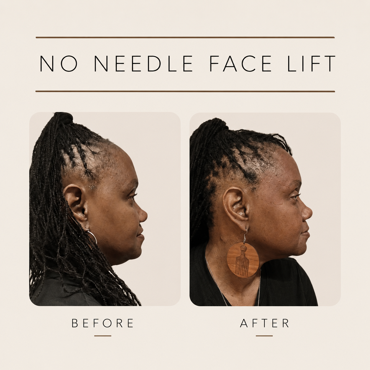 Side Profile Comparison of Woman Before and After Non Surgical Facelift