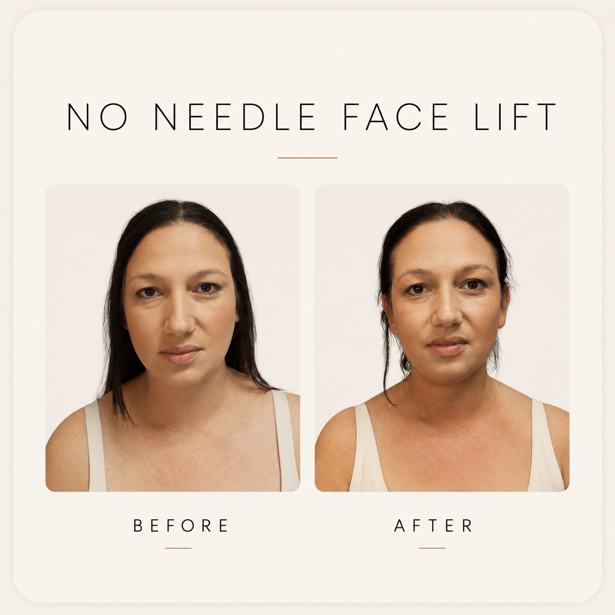Before and After Views of Non-Surgical Facelift Showing Face Tightening
