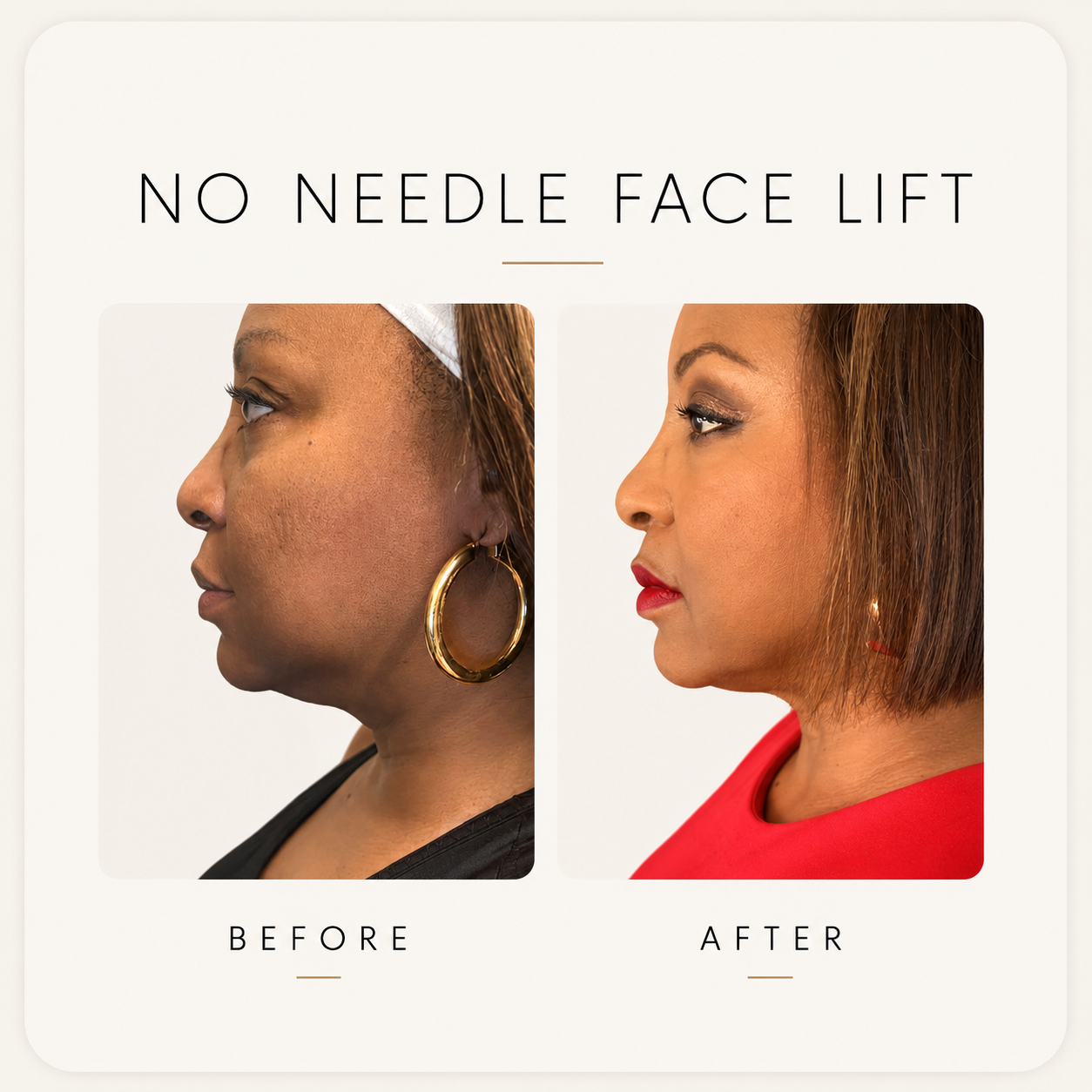 Before and After Non Surgical Facelift Showing Visible Skin Tightening