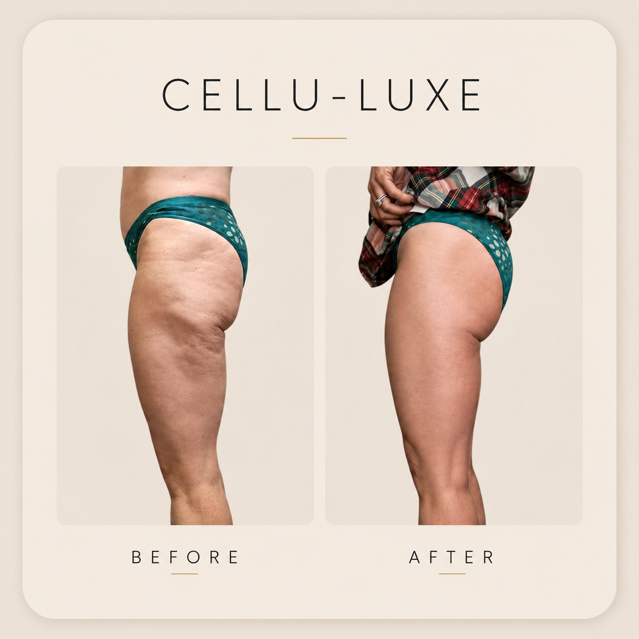 Before and After Cellulite Reduction on a Woman's Thighs