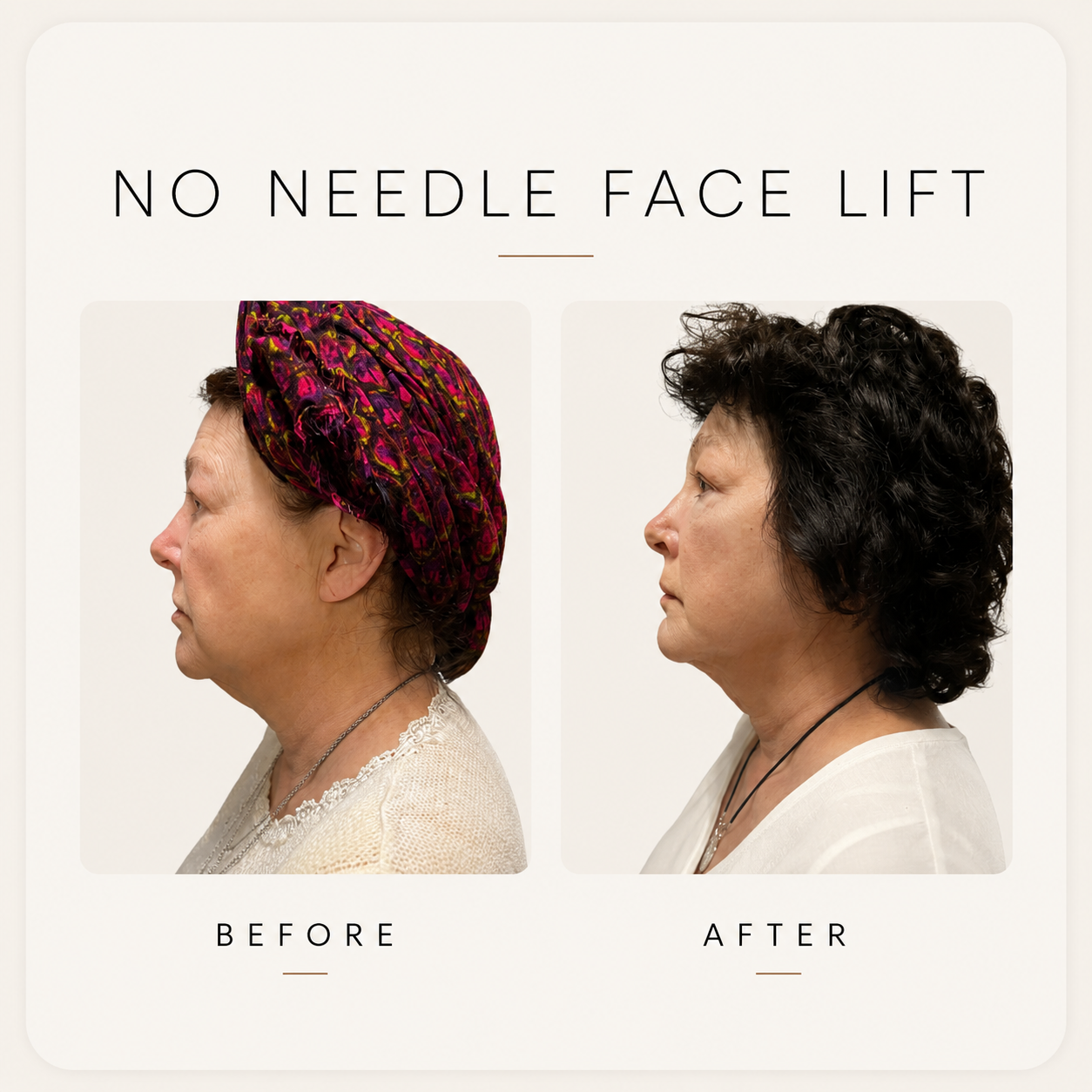Before and After Non Surgical Facelift Showing Tightened Skin
