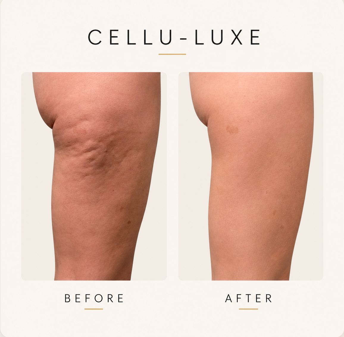 Before and After Cellulite Reduction on Thighs