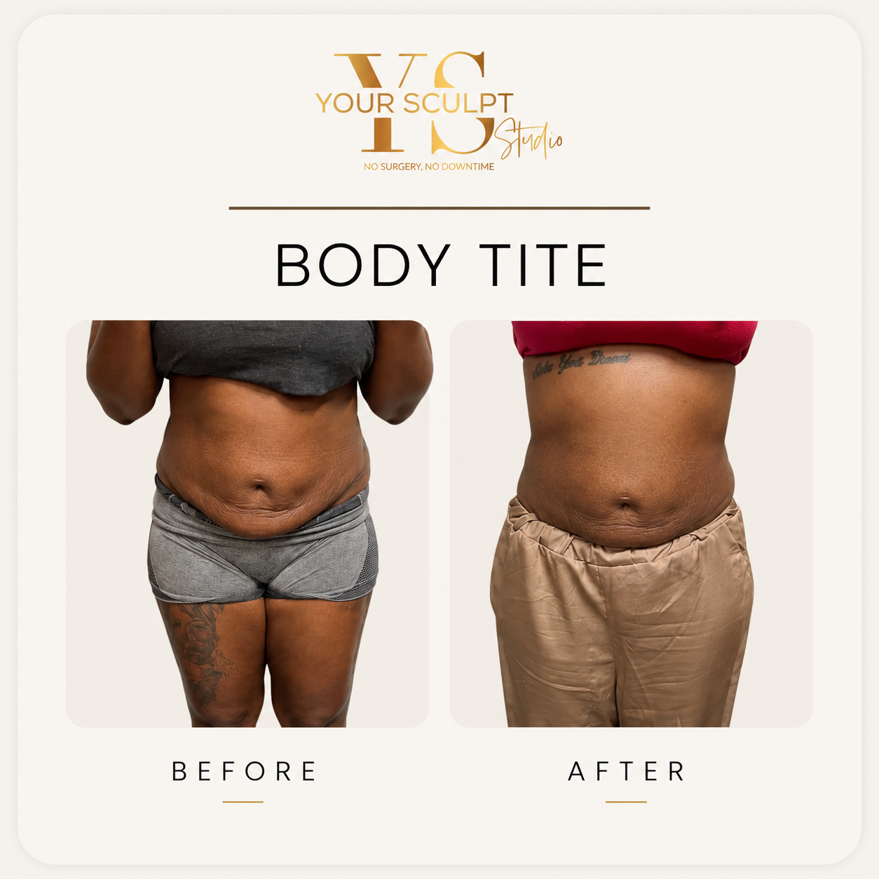 Before and After Results of Non-Surgical Body Contouring Treatment